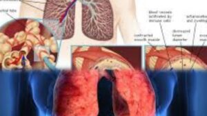Due to falling temperature in winter season and increasing air pollution, the problem of asthma becomes more serious than before, how to control it… Know from FIFA Physiotherapist Dr. Kushal Tiwari….