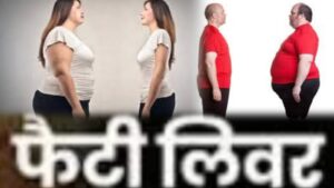  Are you also troubled by fatty liver? So include these panacea things in your diet… also do these things daily, then you will never have liver problems.